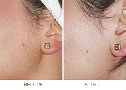 alkiline was treatment