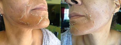 DNA Lacto Ionic peel  treatment